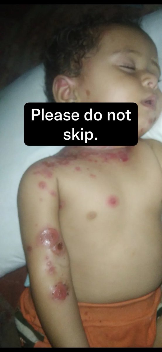 fares__2001's tweet photo. I NEED TREATMENT😭

︎
︎

︎

︎

︎
︎

︎

︎

︎

we’ll remind you 🥺
︎

︎

︎

︎

︎
︎

︎

︎

︎

︎
︎

︎
︎

︎
︎

︎

︎

︎

︎
︎

︎

︎

︎

that
︎

︎

︎

︎

︎
،
︎
︎❗️❗️

︎😭😭
︎

My child has scabies, please help me. 

https://t.co/MT2Xd10Mhd https://t.co/2bXCxBohAs