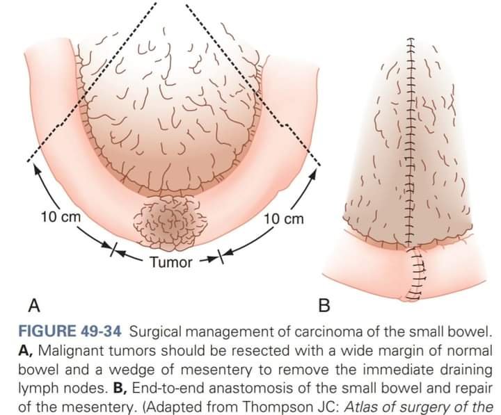 DrJStewart_GS's tweet photo. Jejuno-ileal adenocarcinoma: Segmentectomy + 5-10cm margin + wedge mesenterectomy (≥8 LNs, aim 12) + E-E anastomosis. Terminal ileum → Right hemicolectomy. Update: Laparoscopic OK, MSI mandatory. 

#SoMe4Surgery #MedTwitter #SmallBowelSurgery https://t.co/ZZN1aCfhZ3