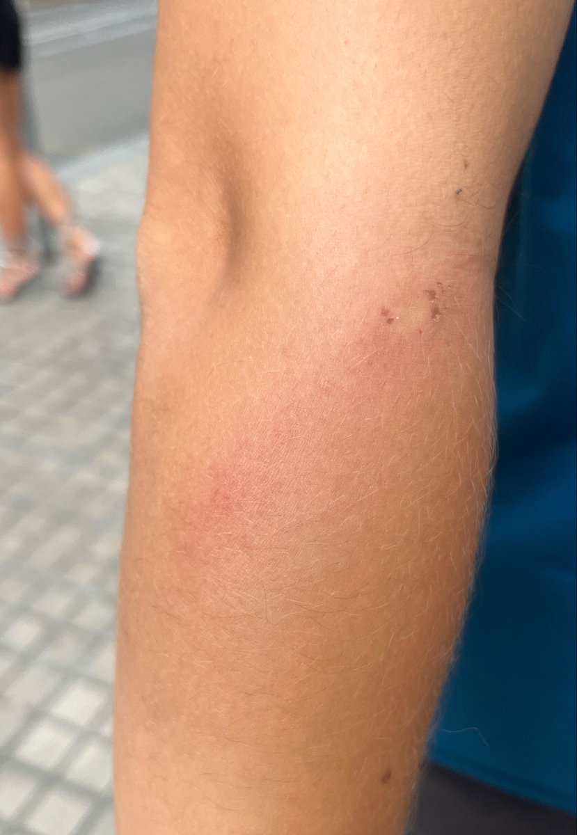 Ire412002's tweet photo. ahir vaig rebre per no portar esvàstiques tatuades, sinó hauria tornat escortada a casa https://t.co/0WQ6GpyiLG