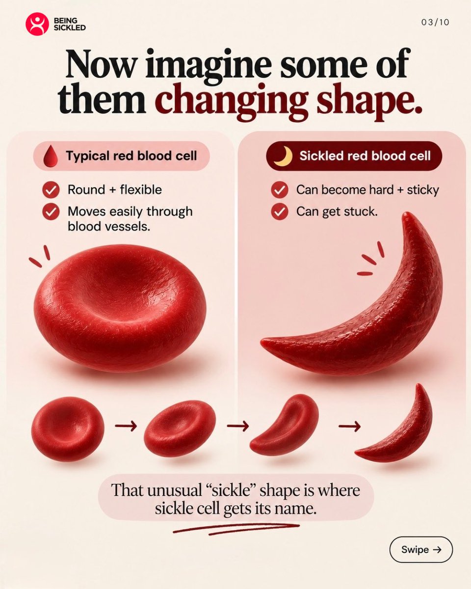 beingsickled's tweet photo. Okay, but what actually IS sickle cell?
We hear about sickle cell all the time, but not everyone understands what's actually happening inside the body.
Here's a simple breakdown without the medical textbook.
#SickleCellAwarenessMonth #beingsickled #sicklecell https://t.co/bv4U0azj6P