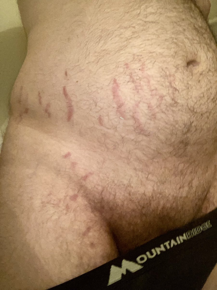 SundaeSloth's tweet photo. Stretch Mark Appreciation Post https://t.co/6RTw8SsykQ