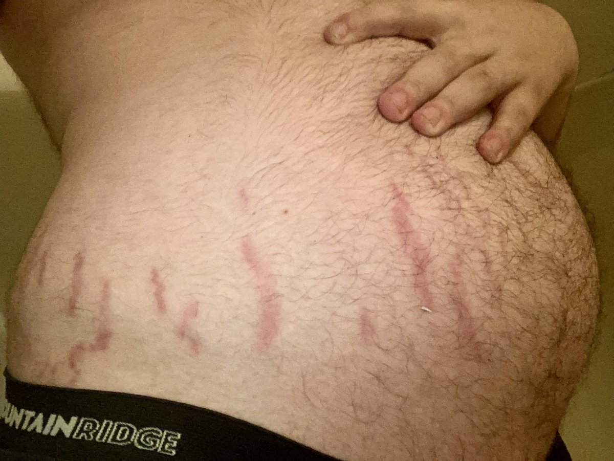 SundaeSloth's tweet photo. Stretch Mark Appreciation Post https://t.co/6RTw8SsykQ
