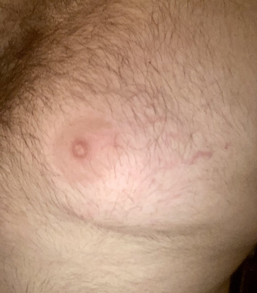SundaeSloth's tweet photo. Stretch Mark Appreciation Post https://t.co/6RTw8SsykQ