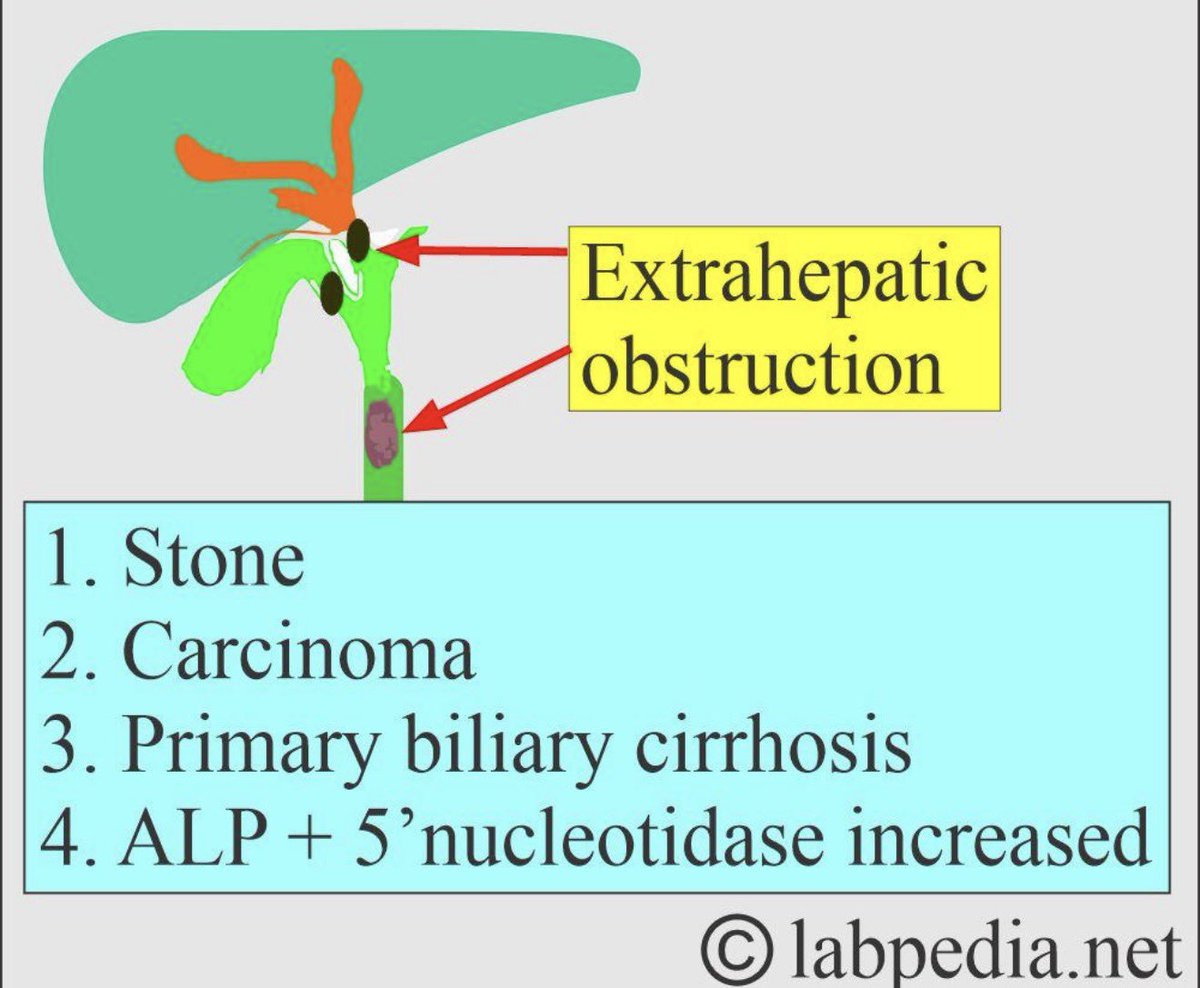 laboratorykh's tweet photo. 🧪 5′-Nucleotidase (5′NT) | علامة مهمة في Biliary Obstruction

عندما يحدث انسداد في القنوات الصفراوية (Biliary obstruction)، يرتفع نشاط ALP بشكل واضح، لكن ALP قد يرتفع أيضًا بسبب أمراض العظام 🦴

هنا يأتي دور 5′-Nucleotidase:

Biliary obstruction → ALP ↑ + 5′NT ↑

📌 لأن 5′NT يرتفع في أمراض الكبد والقنوات الصفراوية، ولا يرتفع عادةً في أمراض العظام؛ لذلك يساعد في تأكيد أن ارتفاع ALP له مصدر Hepatobiliary وليس bone

🎯 مثال :

ALP ↑ + 5′NT ↑
→ فكّر في Cholestasis / Biliary obstruction 🟡

ALP ↑ + 5′NT Normal
→ فكّر أكثر في Bone source 🦴

#مختبرات_طبيه