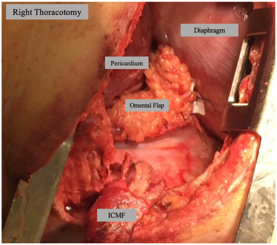 foregut_journal's tweet photo. ⚠️ Atrioesophageal fistula after AF ablation: rare, but potentially fatal.

⏱️ Early recognition is critical
🩻 Rapid diagnosis matters
🚫 Avoid air insufflation &amp; esophageal stenting
🏥 Prompt multidisciplinary + surgical management

🔗 https://t.co/4CkApSNRSD https://t.co/zWKHPzw8LE