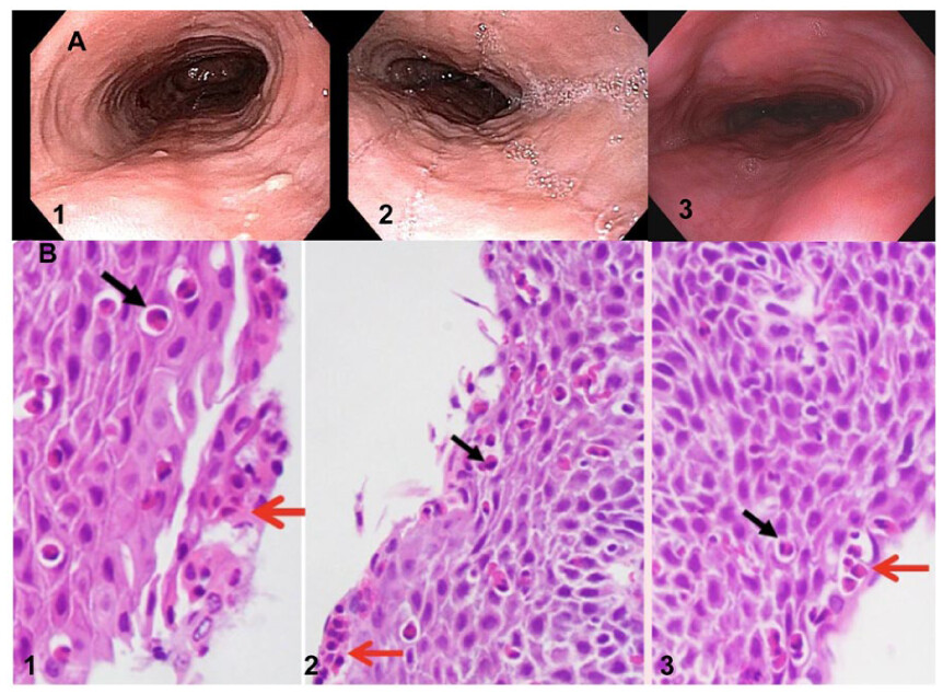 foregut_journal's tweet photo. 🔎 Could PPI therapy be masking eosinophilic esophagitis?

⚠️ EoE and GERD symptoms can overlap
💊 PPIs may obscure endoscopic findings
🔬 Diagnostic timing matters
⏳ Delayed diagnosis can have downstream consequences
🔗 https://t.co/wSYzZXYm0g
#EoE #GERD #Endoscopy #Foregut https://t.co/TOpEwt7UAd