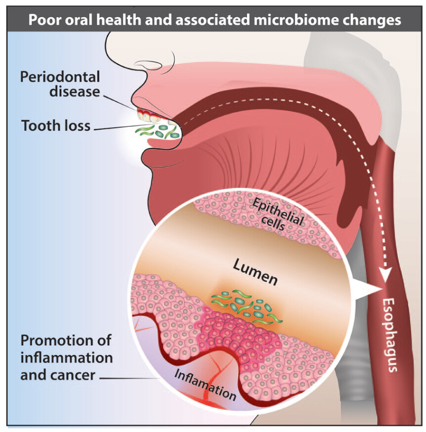 foregut_journal's tweet photo. 🦠 What role does the microbiome play in esophageal cancer?

🔬 Emerging evidence links bacterial dysbiosis to esophageal carcinogenesis

⚠️ F. nucleatum &amp; P. gingivalis have been associated with ESCC biology and outcomes
🔗 https://t.co/6q1gKHIIdr https://t.co/v4aCOZhesH