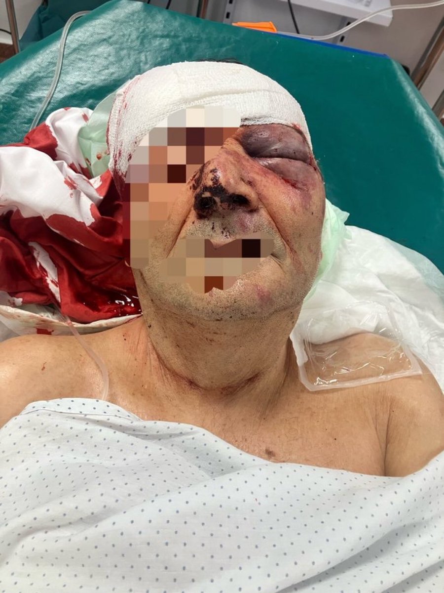 herqles_es's tweet photo. 🇪🇸🇲🇦 #Urgente | Paco, un anciano de 81 años, ha sido salvajemente apaleado en Lorca por un grupo de presuntos marroquíes según informan fuentes locales. https://t.co/ugFPKlOXGF