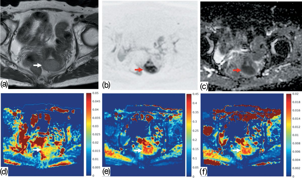 in_magnetic's tweet photo. Can MRI predict endometrial cancer aggressiveness before surgery? This study tests MPM-based amide proton transfer APT imaging for tumor grading, histologic typing, LVSI, and recurrence risk. A promising biomarker beyond ADC. #MRI #EndometrialCancer #CEST https://t.co/NYqSynZi0u https://t.co/07Wkzmc57v