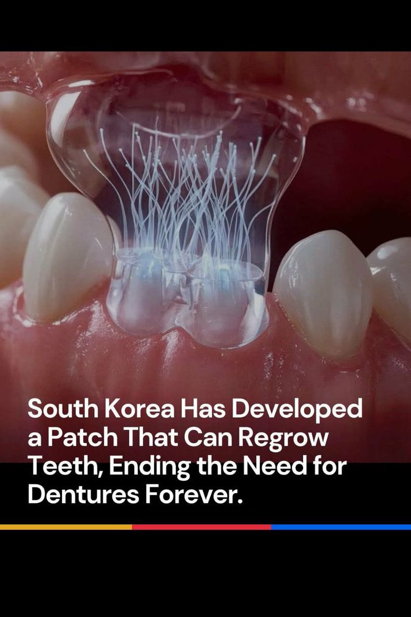 CaptKylePatriot's tweet photo. 🦷 South Korean scientists have unveiled a groundbreaking dental innovation — a tiny bioactive patch capable of regrowing real teeth naturally, potentially ending the era of dentures.

Instead of relying on artificial implants, this patch activates the body’s own stem cells inside the jaw, kick-starting the regeneration of enamel, dentin, and even full tooth structures.

Placed directly over the site of a missing tooth, it delivers precise biochemical signals that awaken dormant regenerative pathways, allowing a new tooth to grow from within the gums — complete with natural function and sensation.

If upcoming human trials continue to show success, this technology could revolutionize dentistry, giving millions of people the ability to regrow their own teeth for the first time in history.

- Brian Clark

Join: @Free_Energy⚡️