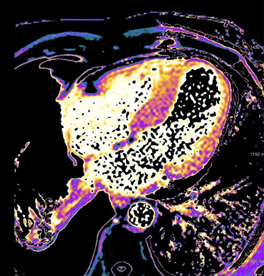 radiology2022's tweet photo. 心臓アミロイドーシスのCT所見
✅典型的には求心性の左室壁肥厚。内腔は正常〜小さめ
✅両心房拡大＋心嚢液。右室壁・心房中隔の肥厚も
✅遅延造影CTでびまん性の心内膜下〜全層性増強、心筋ECV上昇
💡通常胸部CTは疑うきっかけ。形態所見だけで確定せず、心エコー・MRIなどで精査へ。

#rdiag https://t.co/mR2nbcx8xh