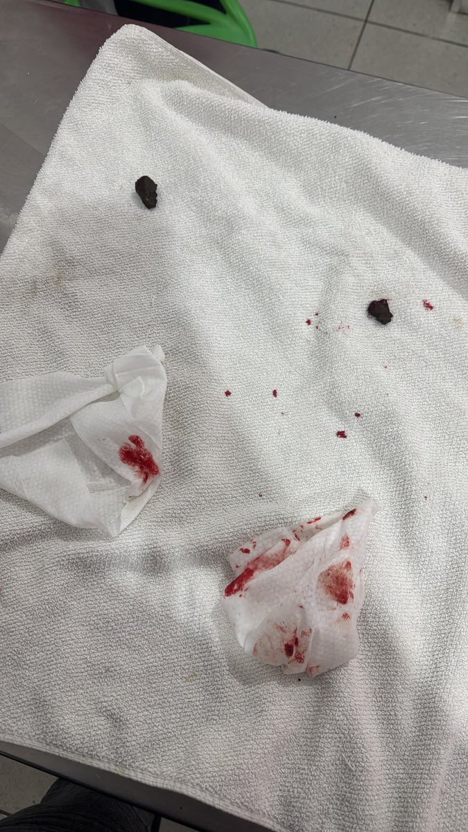AbrigoMeimei's tweet photo. PRECISAMOS DE AJUDA — GATO PERSA CEGO ESPANCADO EM LAR TEMPORÁRIO

Eu não caibo em mim de tanta indignação. 

Duck chegou ao abrigo tem uma semana após o pedido de uma moça. Disse que o resgatou há menos de 3 anos já cego e após uma mudança para outro país, deixou com alguém “de confiança”. Agora, sem data prevista de volta, a tal pessoa não poderia mais ficar com o gato e por isso nos procuraram.

Ela aceitou ajudar com seus gastos iniciais e logo organizou a vinda dele. A pessoa que o trouxe me entregou ele como se fosse uma encomenda. Foi quase ríspida, estranha, me deixou até mal. 

Nos dias que ele esteve aqui (entre 2 e 3) ele comia desesperadamente, chegou a comer 3 sachês seguidos como se estivesse com fome há dias. Achei estranho, mas pensei “às vezes só não comia sachê e gostou muito, normal”. 

Até antes da vinda dele pedi para minha amiga e veterinária @/mi_brandino que fosse lar temporário dele, porque ela tem muito conhecimento de gatos persas. Quando eu fui levar ele, ela ficou surpresa com o estado dele (que eu, por não conhecer detalhes da raça, não notei).

Além de cego, ele mancava de dor por dificuldade de evacuar. Quando conseguiu, com ajuda de supositórios, sangrou muito (fotos no post). Ele estava muito magro, com uma sede absurda. A Dra Milenna viu que não seria um problema resolvido apenas com probióticos e alimentação, então fez exames de sangue e ultrassom, que confirmaram: Duck foi ESPANCADO, tem lesões internas, além das evidências de maus tratos por ter emagrecido demais nos últimos meses de acordo com as fotos.

Agora, nessa situação, a pessoa que nos pediu ajuda assumiu que ele foi comprado em um gatil que fazia cruzas entre gatos da mesma família, então a cegueira dele provém de problemas genéticos. 

O problema é que, além de tudo, essa pessoa não quer ou não pode denunciar quem estava maltratando o Duck porque provavelmente é da família dele. Então agora a recuperação do Duck é problema nosso.

Precisamos pagar:

👉 Ultrassom (R$ 200)
👉 Hemograma com FIV e FeLV (R$ 300)
👉 Raio-x (R$ 250)

Além de custear fraldas e alimento a base de fibras pra ele conseguir defecar sem dor.

Peço encarecidamente a ajuda de cada um de vocês pra gente salvar essa vida que já sofreu tanto.

👉 Pix: 11985816168 em nome de Lorena Tuxen (Nubank).

Agradeço desde já quem puder somar com a gente nessa luta por ele.