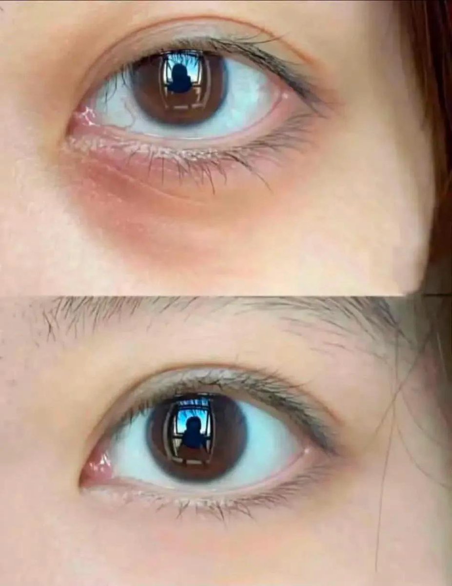 ftriee26's tweet photo. sumpah, area bawah mata tuh ternyata ngaruh banget ke muka keliatan fresh atau nggaknya 😭

akhirnya aku nemu eye gel yang beneran ga overclaim huhuu😭

udah aku pake kurang lebih semingguan lebih dan ternyata suka banget sama hasilnya 🥹 https://t.co/ZRKec9sJbF