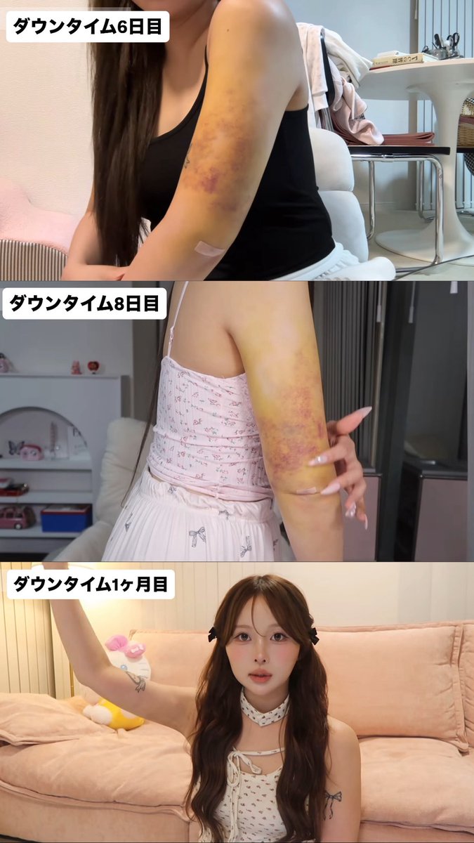 b_rinnatural's tweet photo. ももちゃん、二の腕の脂肪吸引したらしい。確かに別人級に細くなってて綺麗だけど、こんな痛々しいダウンタイム乗り越えてたと思うと尊敬でしかない… https://t.co/Fd32Dka80x