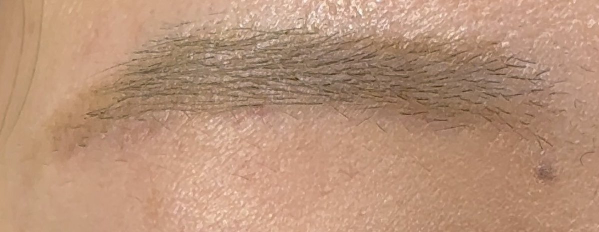 dr_egoh's tweet photo. 眉下切開は傷跡を気にされる方が多いですが、私は傷の下から眉毛が生えてくるように切開することを意識しています。

生えた毛が傷を自然に覆ってくれるので、時間が経つにつれ傷そのものが分かりにくくなっていきます。

【眉下切開について】
費用：363,000円（税込）
主なリスク・副作用：腫れ、内出血、傷跡が一時的に赤くなる、左右差、まれに感覚の変化など
施術時間の目安：片眼40分程度
抜糸は術後1週間が目安です。傷が周囲の皮膚になじみ、目立ちにくくなるまで3ヶ月程度を見ていただくことが多いです。