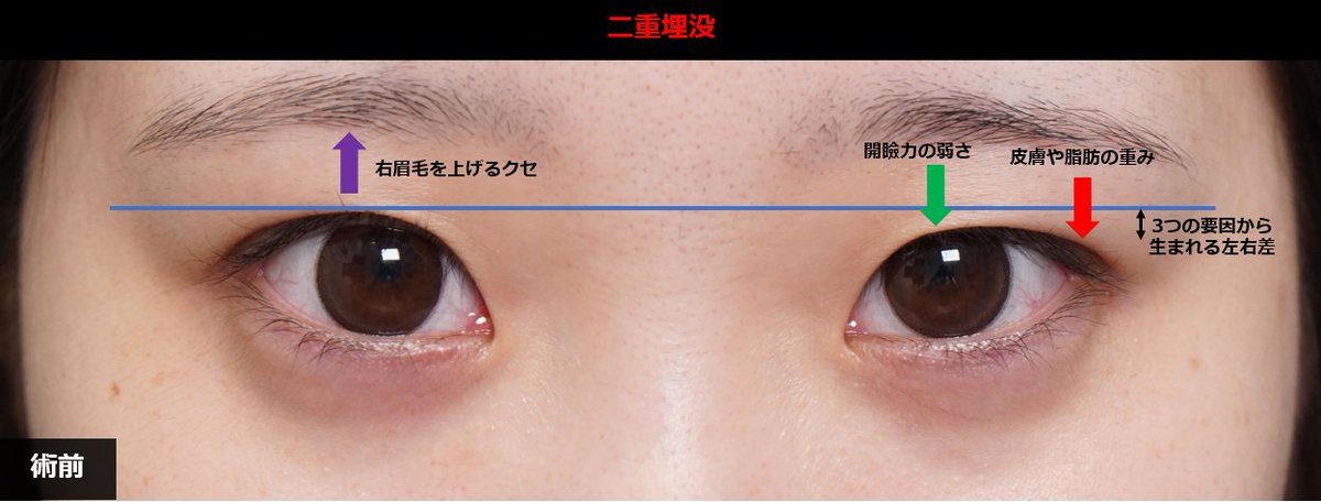 dr_egoh's tweet photo. 「もともとの左右差があり、同じ幅で留めても揃わないのではないか」というご相談をよくいただきます。

この方は右眉を上げるクセに加え、左側の目の開き、皮膚や脂肪の重みという3つの要因から左右差が生じていました。目を開けたときのバランスを整えるため、あえてデザインの段階で左右の幅にわずかな差をつけて固定しています。

術直後は多少の非対称が目立つ時期もありますが、時間の経過とともに馴染んでいきます。事前の見極めが、仕上がりの安心につながると考えています。