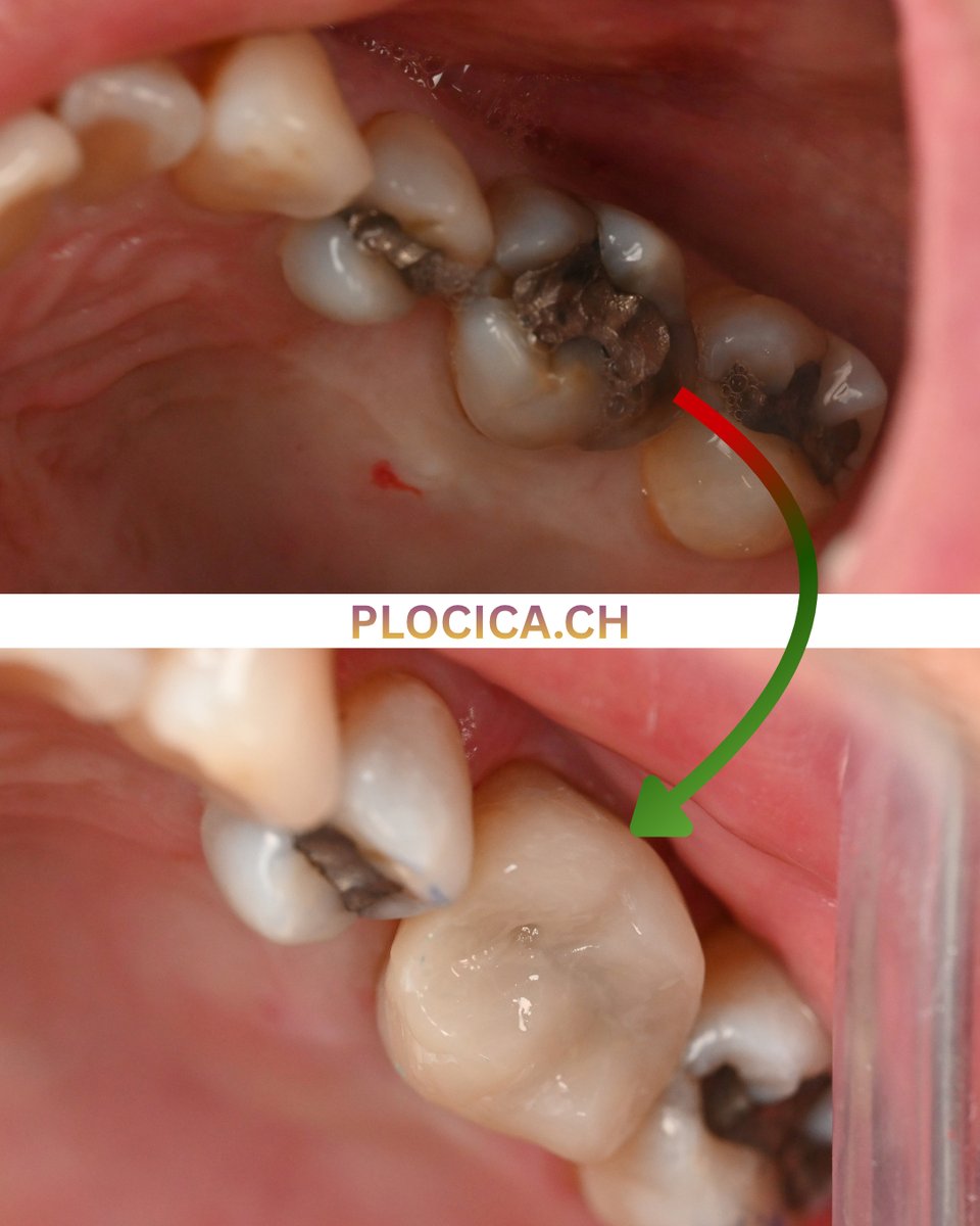 plejta's tweet photo. Aus alt und belastet wird wieder stabil und natürlich: Dieser Backenzahn bekam eine präzise Versorgung, die Funktion, Form und Ästhetik zurückbringt. Ein kleines Detail mit grossem Unterschied im Alltag – beim Kauen, Sprechen und Lächeln. 🦷✨ https://t.co/JRGVKZrbnZ