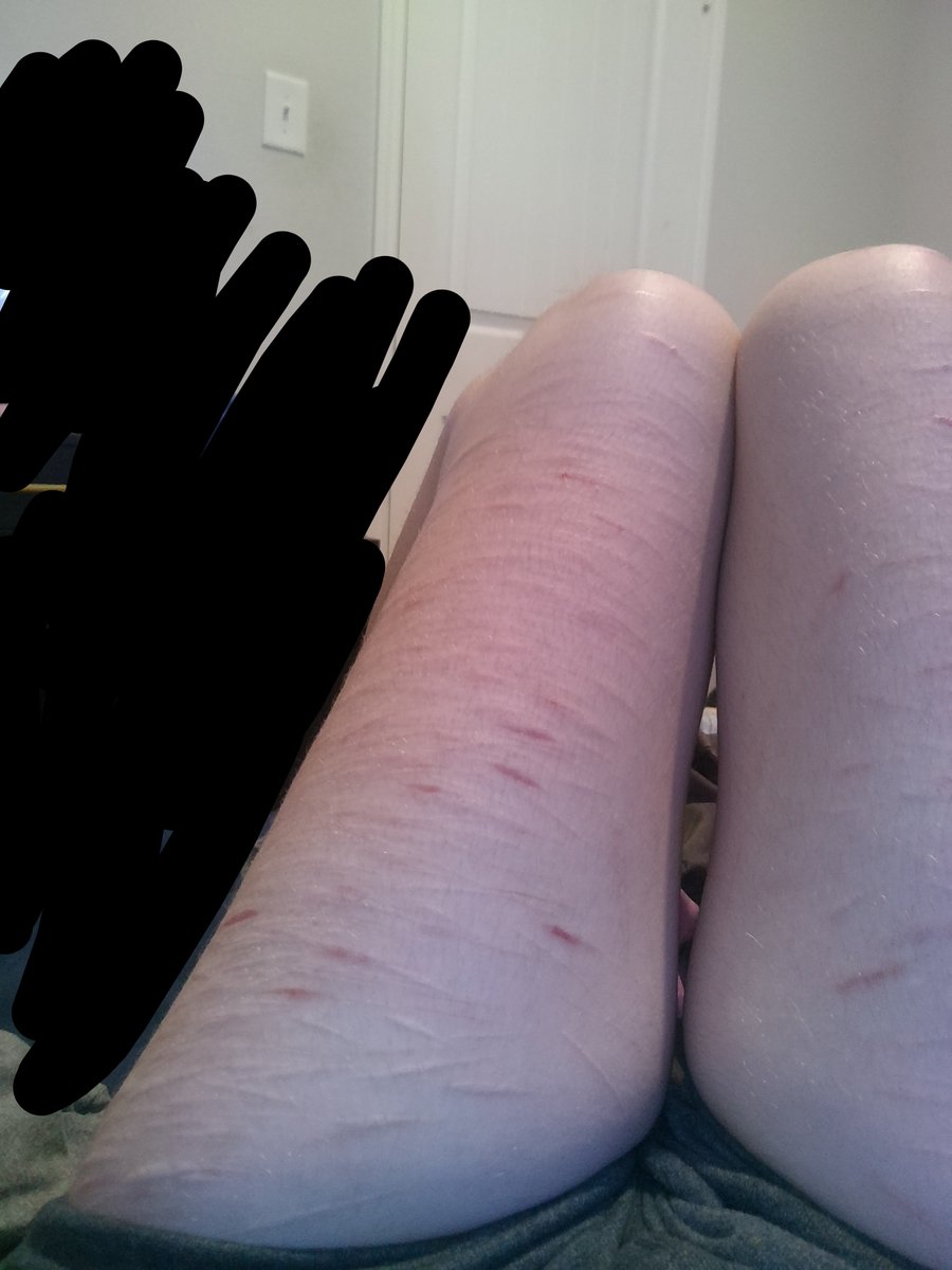lyyyx0_0's tweet photo. scasrsrstssh wow how disgusting bro omg lkirekek...ok..dude..my..gf would not like me omg how do I even🤔🤔ugh ok...yes..yes...
#shhtwt #stryotwt #ouchietwt #scars https://t.co/INGbELyzqR