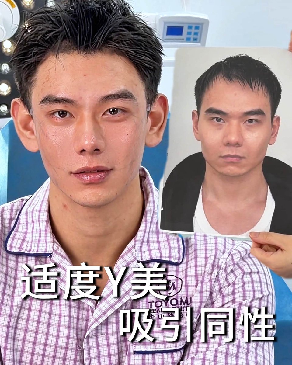 malkymacaulay's tweet photo. This programmer’s transformation was more than just a new hairstyle. Long hours, late nights, and a high-pressure lifestyle had left him looking tired, undefined, and older than he felt. After a detailed consultation, Dr. Xiao created a https://t.co/05edh86Mh1