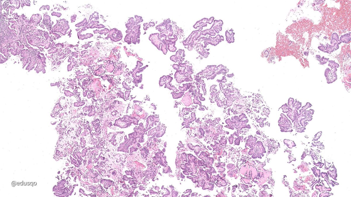 edusqo's tweet photo. Cell block from a fine-needle aspiration (FNA) 💉. No anesthesia, costing mere cents. FNA offers certainty through 🔬 in situ evaluation with the patient present, providing exceptional samples and diagnoses while optimizing resources. What more could you ask for? #Pathology #ROSE https://t.co/huBel249W5