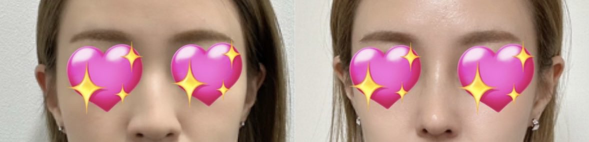 _____xxkrm's tweet photo. 渡韓鼻フル(48万)から3年経過🇰🇷
3年間トラブルなし！約1年かけて10件以上カウンセリングを巡り、時間をかけて決めたクリニック･執刀医公開しています。巡った所の見積もり比較シートもダウンロードできるよ💌韓国での鼻整形を考えてる人の参考になれば嬉しいです！
https://t.co/5hiELsnDLW https://t.co/SZUKIB1U7e