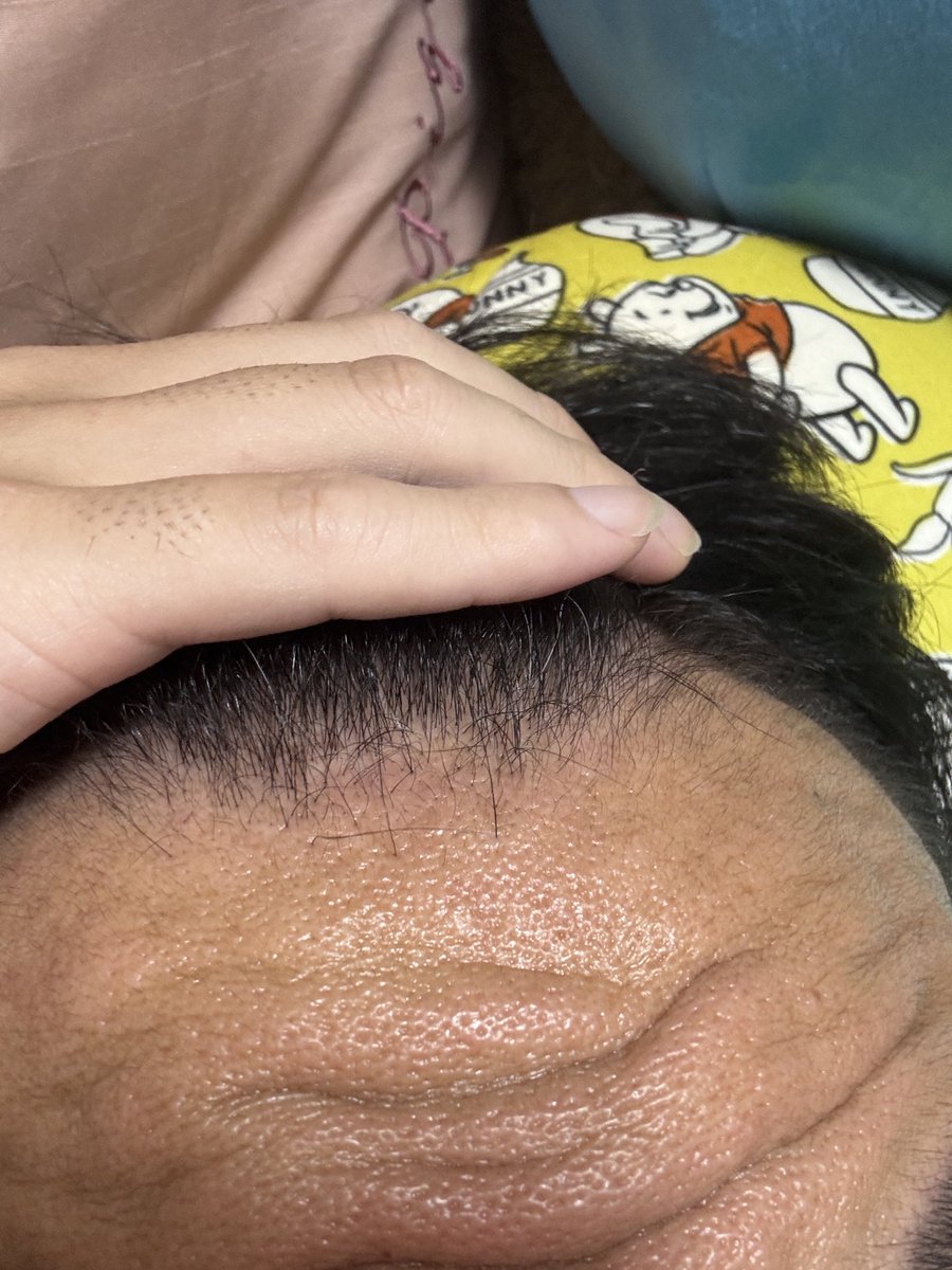 yaruo_s's tweet photo. 9/13 970日目経過観察。
真ん中、左、右の画像。ミノキシジル5mg→10mg。特に変化なし。#AGA #ハゲ #生えてきた https://t.co/kUnBobQBz0