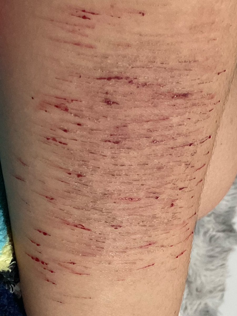happiesturethan's tweet photo. (FAKE REALISTIC MAKEUP)

my left arm looks crusty af and now its HARD TO CUT DEEPER BC OF IT..

#shtwt #cuttwt #slittwt #ouchietwt #fake #slit #cut https://t.co/8zZxHCvfx2