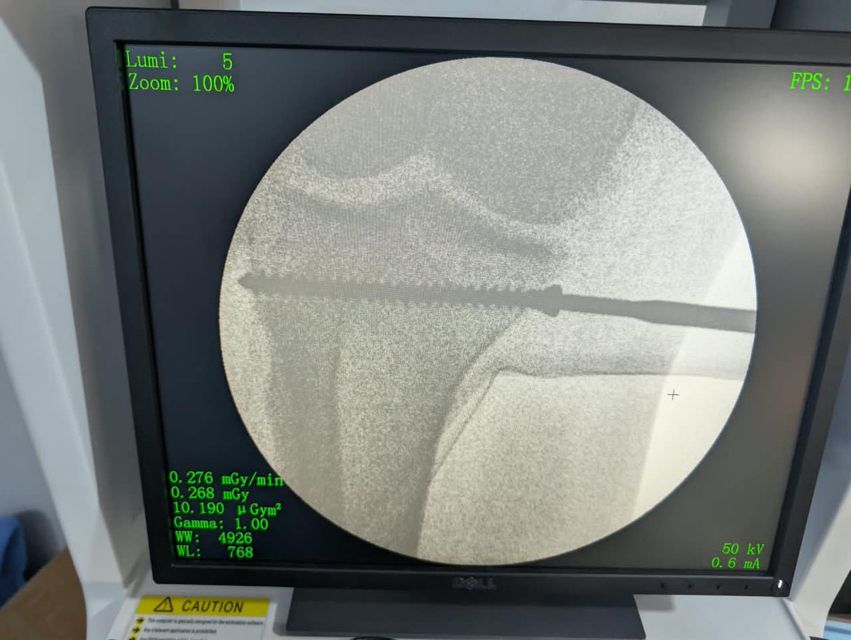 asalaortho's tweet photo. She presented on account of INABILITY TO USE BOTH UPPER AND LOWER LIMBS.

An assessment of CERVICAL MYLORADICULOPATH WAS MADE.

MRI reveals SEVERE CERVICAL COMPRESSION FROM BOTH C5/6 DISC COMPRESSION AND THICKENED LF POSTERIORLY.

She has 360 cervical surgery.

FRAME 2 is second day post op

@InsideOsogbo @Tuffmallam @SirBosun