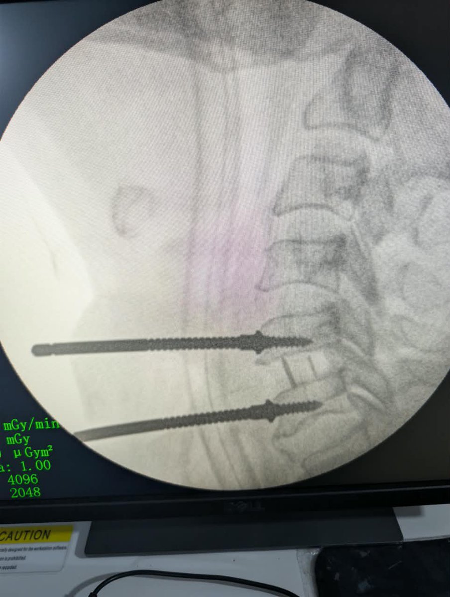 asalaortho's tweet photo. She presented on account of INABILITY TO USE BOTH UPPER AND LOWER LIMBS.

An assessment of CERVICAL MYLORADICULOPATH WAS MADE.

MRI reveals SEVERE CERVICAL COMPRESSION FROM BOTH C5/6 DISC COMPRESSION AND THICKENED LF POSTERIORLY.

She has 360 cervical surgery.

FRAME 2 is second day post op

@InsideOsogbo @Tuffmallam @SirBosun