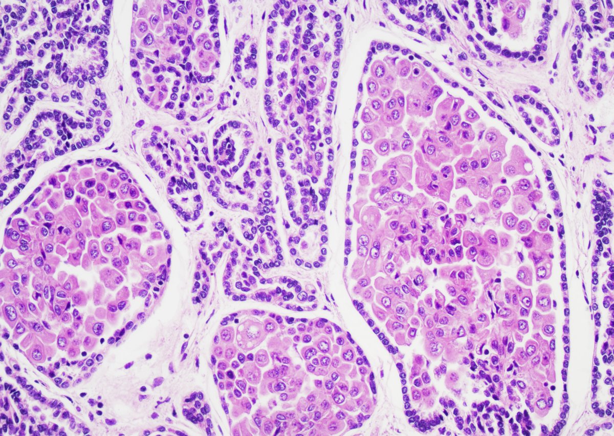 GuannanTiffany's tweet photo. 🧩 Kidney riddle

Rare, certainly, but what a special morphology!

A little question for the stain nerds: which stain would you try?

#DxMindMap #KidneyPath #GUPath #PathTwitter @JHUpath @MGBpathology https://t.co/I3NQurdYns