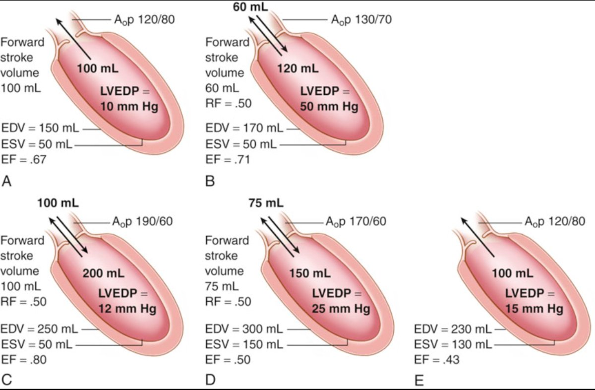 TrackYourHeart's tweet photo. Aortic regurgitation: why can EF be misleading?

In severe aortic regurgitation, the LV ejects blood in two directions: forward into the aorta and backward into the LV.

That changes how we interpret stroke volume and EF.

⬜ Acute severe AR: Total stroke volume rises, but forward stroke volume falls. LVEDP rises sharply.

🟧 Chronic compensated AR: LV dilates and develops eccentric hypertrophy. EDV increases, allowing both total and forward stroke volume to rise while filling pressure remains relatively normal.

🟩 Chronic decompensated AR: LV contractile function deteriorates. ESV rises, EF falls, forward stroke volume falls, and LV filling pressure rises again.

🟥 After valve replacement: EF may initially fall because the low-resistance regurgitant pathway has been eliminated. This does not necessarily mean the LV has worsened. Forward stroke volume improves, and EF can recover with remodeling.

Key point: In severe AR, a normal or high EF does not necessarily mean normal LV function. The LV is ejecting blood both forward and back into the ventricle.

#Cardiology