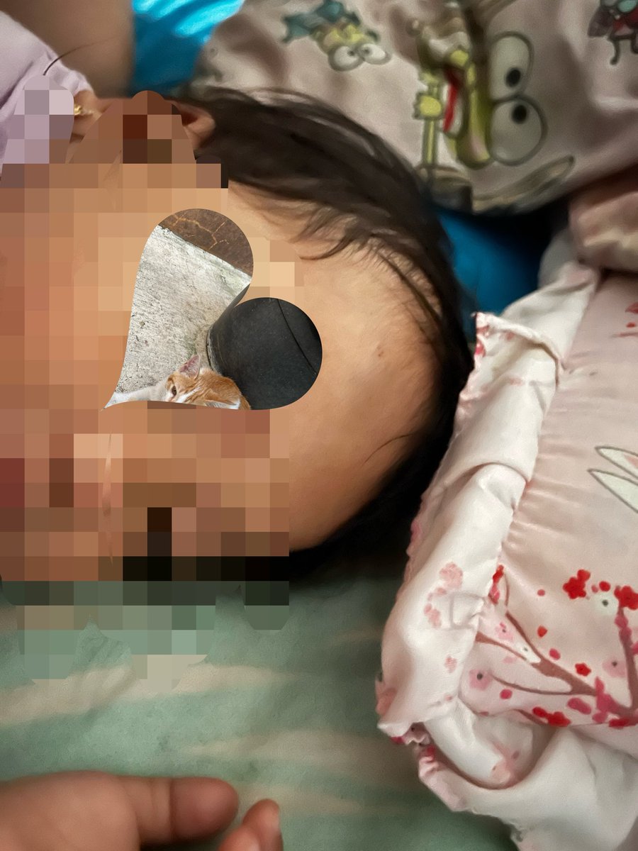childishlyyy's tweet photo. Cokkkk! Kemarin malem anak gua jatuh dan kepalanya benjol bener2 benjol menonjol biru😭 gua gak hanya panik takut dia kenapa2 tapi lgsg ovt takut diomelin mertua juga. Tapi Allah maha baik benjolannya kempes dan tersamarkan pagi ini. https://t.co/BG8XGKFpzg