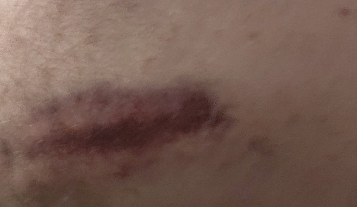 xmonge's tweet photo. Avui massa gent té lesions iguals o pitjors, i @nuriaparlon segueix amagada. https://t.co/yMq8gLRMNQ