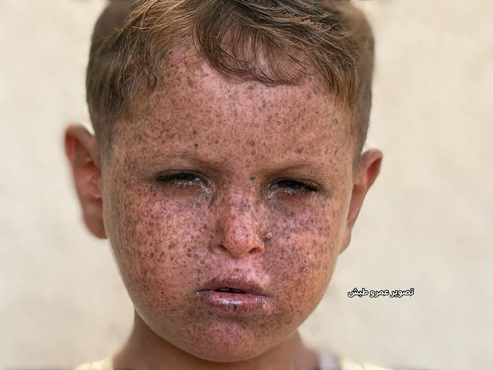 Timesofgaza's tweet photo. Four-and-a-half-year-old Mustafa Safi has suffered since birth from a rare and serious genetic disorder known as xeroderma pigmentosum (XP). The condition severely increases his sensitivity to ultraviolet (UV) radiation and puts him at risk of serious complications, including skin lesions and tumors.
Mustafa’s condition requires continuous specialized treatment and medical follow-up. Doctors have recommended that he be transferred to a specialized medical center outside the Gaza Strip to receive the necessary care.
Mustafa urgently needs intervention to facilitate his evacuation and access to the treatment he needs before his condition deteriorates further, giving him a chance to live safely like other children.