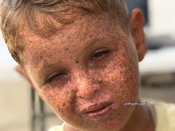 Timesofgaza's tweet photo. Four-and-a-half-year-old Mustafa Safi has suffered since birth from a rare and serious genetic disorder known as xeroderma pigmentosum (XP). The condition severely increases his sensitivity to ultraviolet (UV) radiation and puts him at risk of serious complications, including skin lesions and tumors.
Mustafa’s condition requires continuous specialized treatment and medical follow-up. Doctors have recommended that he be transferred to a specialized medical center outside the Gaza Strip to receive the necessary care.
Mustafa urgently needs intervention to facilitate his evacuation and access to the treatment he needs before his condition deteriorates further, giving him a chance to live safely like other children.