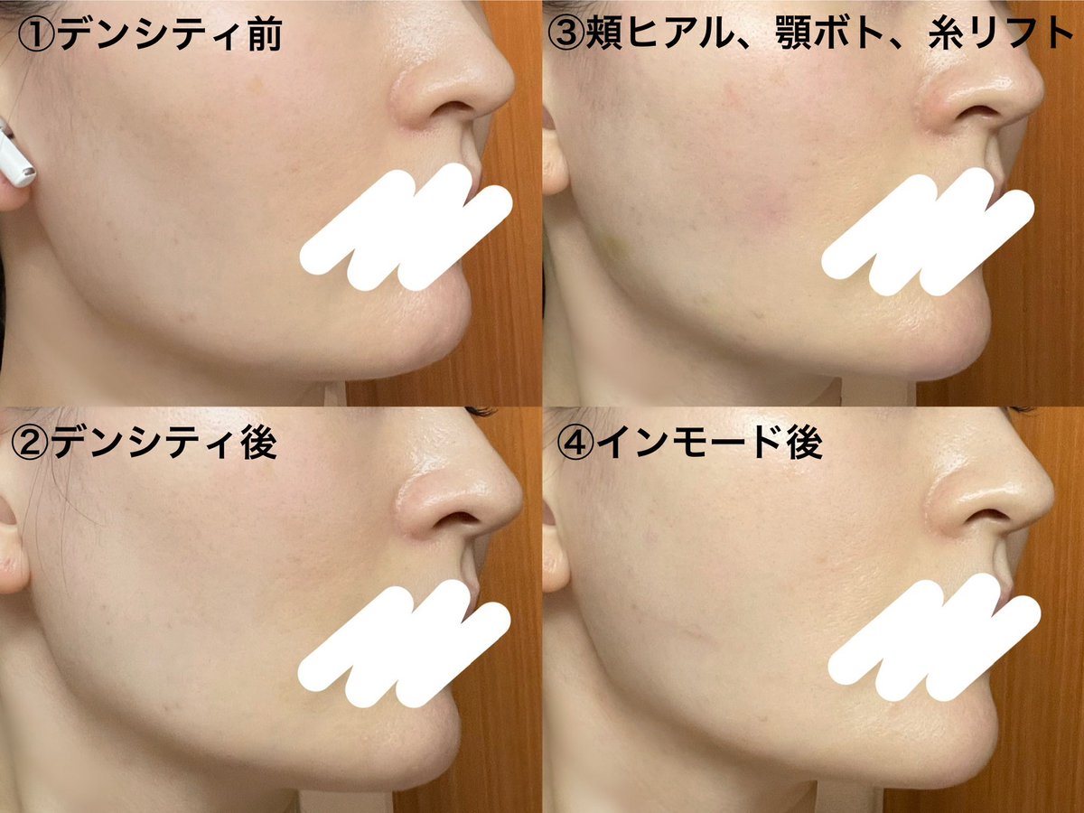 403_faceline's tweet photo. ここ3ヶ月くらいの比較
デンシティの効果はまだ続いてます
横だと分かりにくいけど、③で🔴コケ改善、🟢たるみ改善、あと🔵顎伸びた笑
インモードはまだ変化を感じられてないけど、なんとなくボコついて見えた頬がなだらかになった気が
#整形垢さんと繋がりたい
#美容垢さんと繋がりたい https://t.co/5HxGMmMnNr