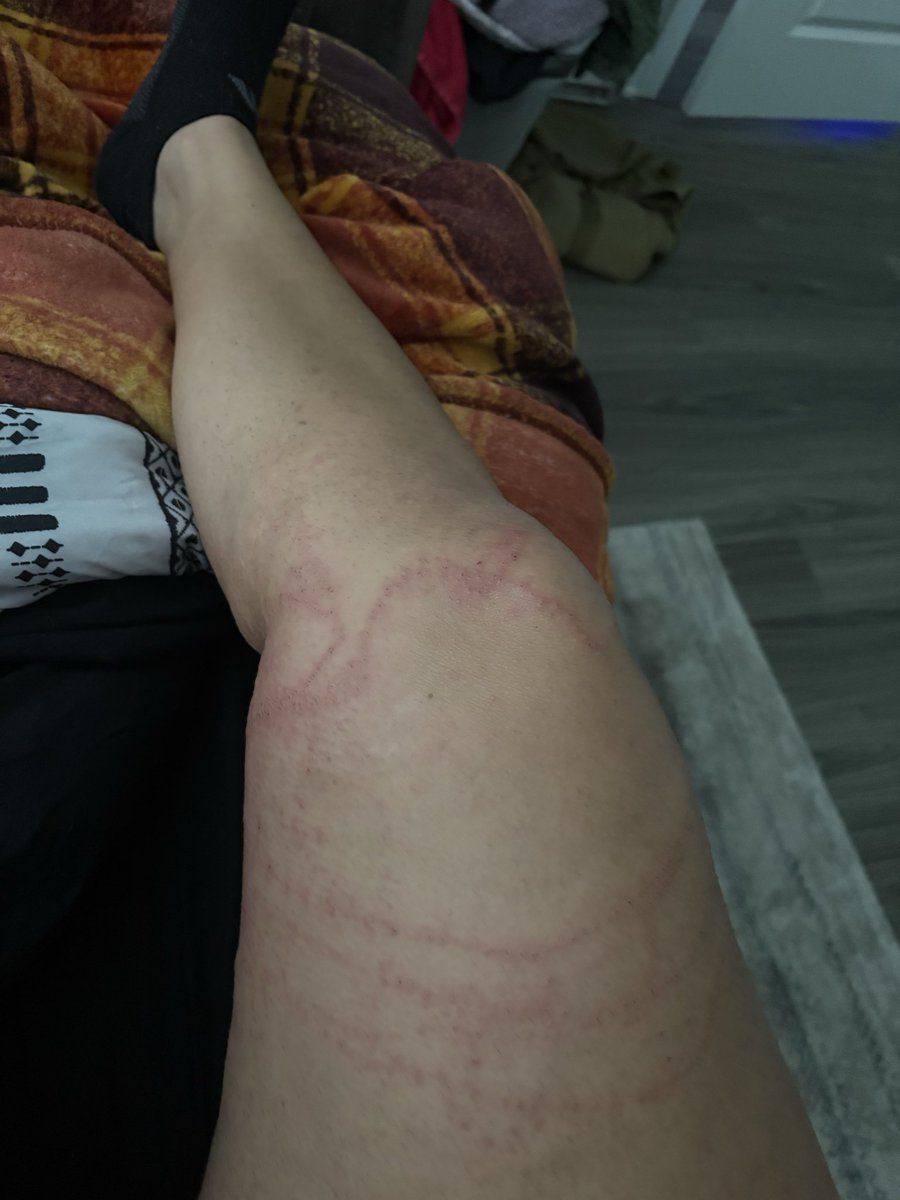KatieStone_26's tweet photo. Fun fact: about a week after getting stung by a jellyfish, it will swell up again and itch like no other https://t.co/CpcnjGia6Z
