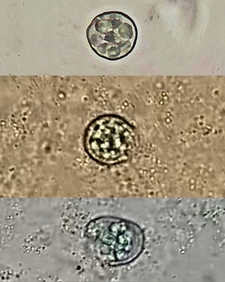 Rommiemicologia's tweet photo. This week we diagnosed a pulmonary Coccidioidomycosis this 3 pics came from the sputum sample. https://t.co/nbXs7LhmRd