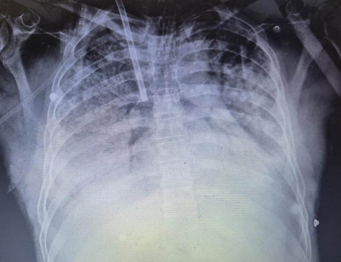 drnavi001's tweet photo. 🚨 Respiratory infections are on the rise in Mumbai.
Recently, we initiated VV-ECMO for a severe leptospirosis case complicated by refractory hypoxemic respiratory failure -a reminder of how rapidly infectious illnesses can progress to life-threatening ARDS.
Early recognition, timely referral and access to advanced critical care can be lifesaving.
#Leptospirosis #ARDS #VVECMO #CriticalCare #Mumbai