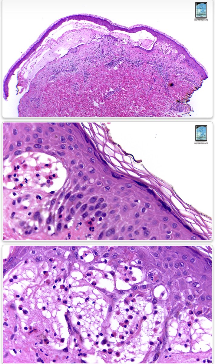 MarcelaSaebL's tweet photo. I just gave a lecture about this.  
This is bullous pemphigoid: IgG antibodies against 180, 230 or p200 kDa antigens within the DEJ (hemidesmosome) and it looks like this: subepidermal inflammatory eosinophilic bulla. 
#dermatopathology🔬💕 https://t.co/iwqaWAWA1x