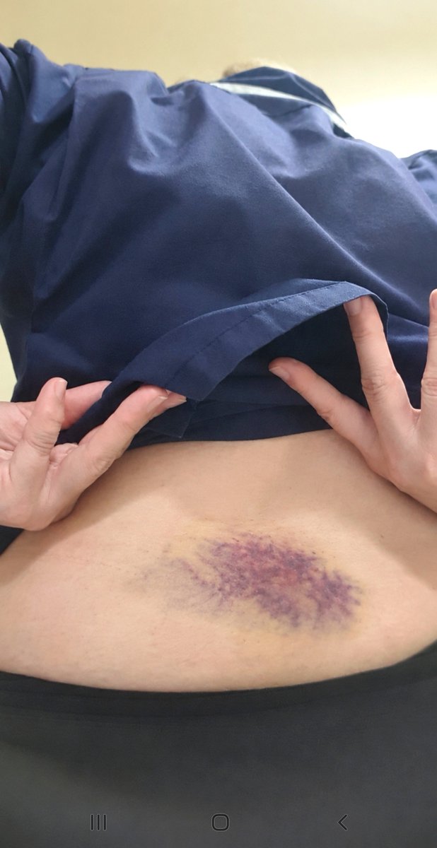 AllyLuvsTim's tweet photo. Took a tumble at work and badly hurt my back 😖 https://t.co/LShzGxxm6q
