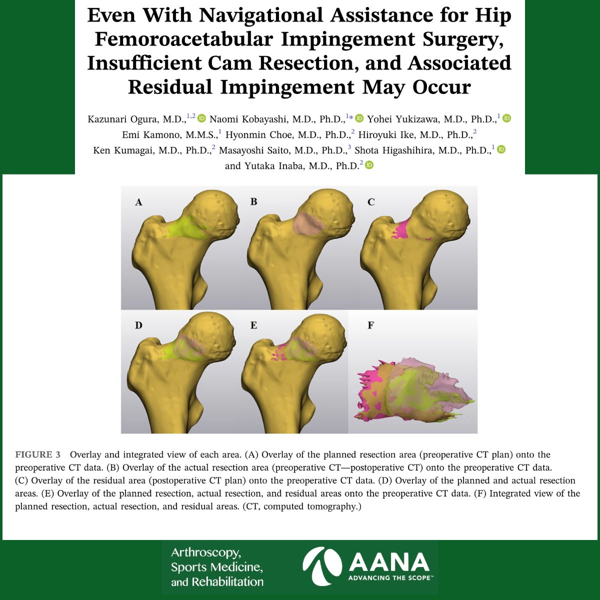 ArthroscopyJ's tweet photo. Even with navigational assistance for hip femoroacetabular impingement surgery, insufficient cam resection and associated residual impingement may persist  #HipSurgery #FemoroacetabularImpingement #CamResection https://t.co/C8dDak0sc3
