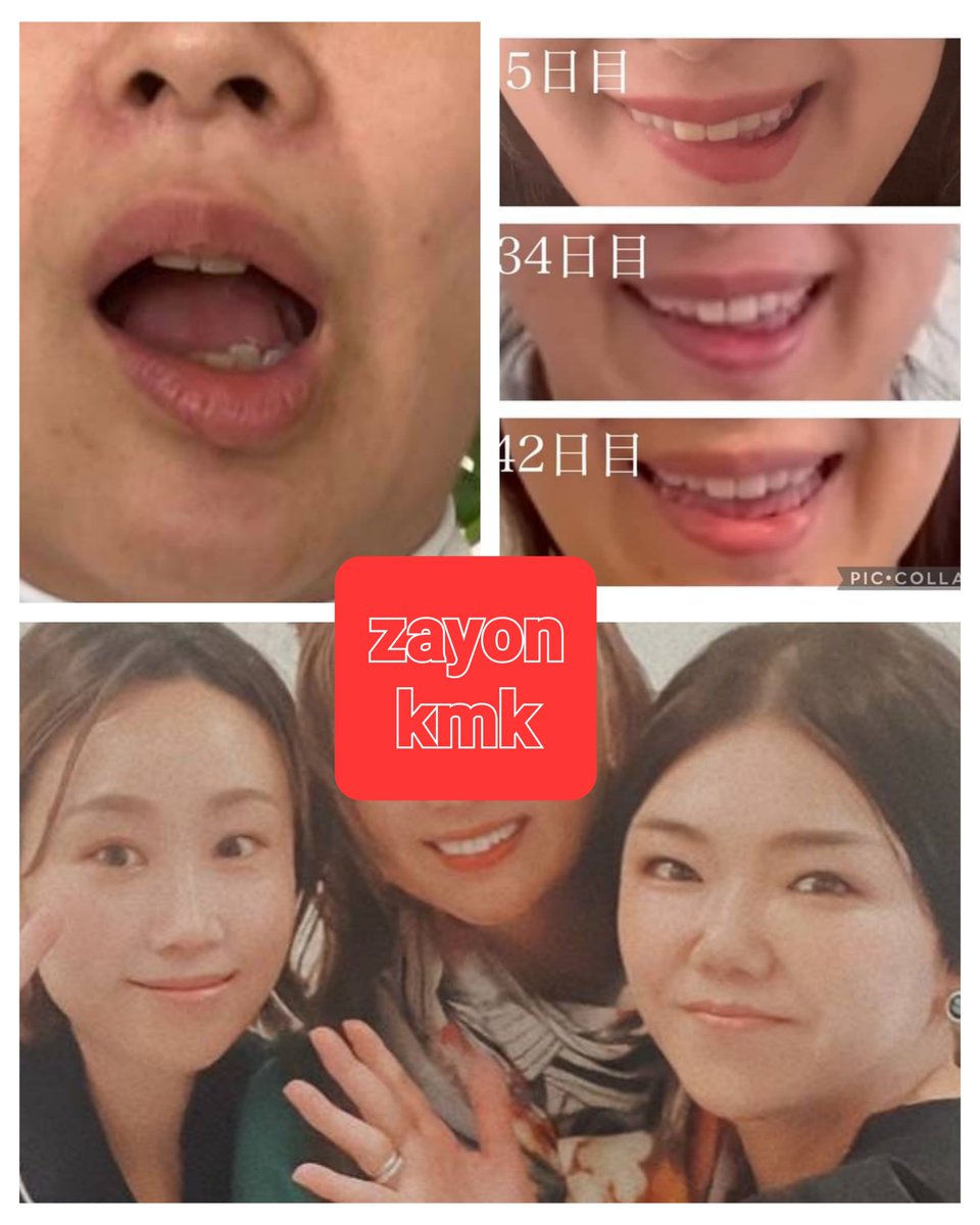 salonzayon's tweet photo. 脂肪吸引による麻痺や拘縮もお任せください！ボトックスによる効きすぎや、バッカル、ショール、メーラー除去による拘縮悩みの方も鍼とザヨンの医療機器でお肌までキレイになりながら拘縮や、違和感も改善してきてます！
https://t.co/Zqz1B51Jos https://t.co/ry1wD2OHX7