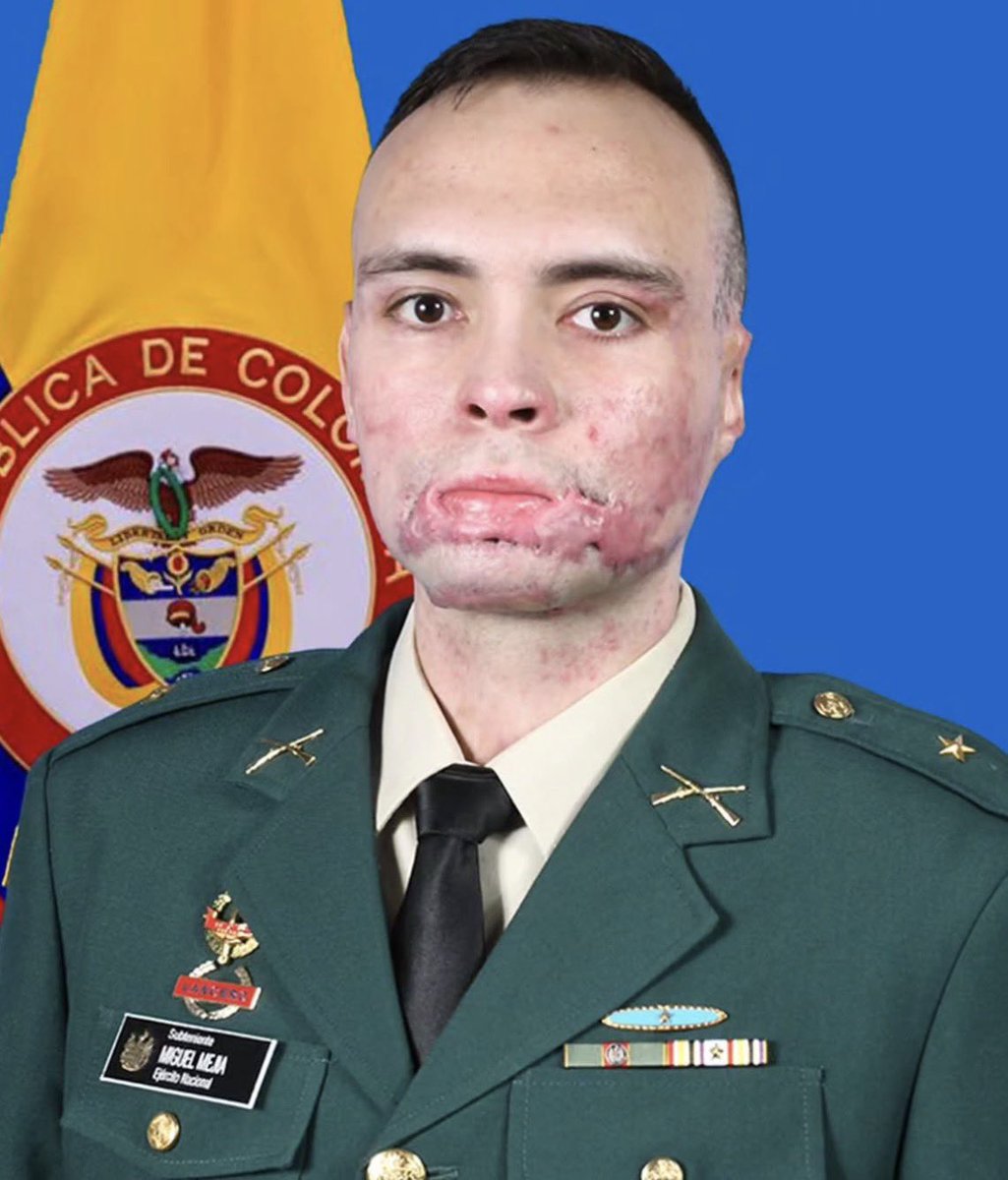 SALVARANM's tweet photo. 🚨 | URGENTE:

Él es el subteniente del Ejército Nacional Miguel Mejía, prendido en llamas por la guerrilla genocida durante el gobierno del mentecato @petrogustavo, vivo de milagro.

< así era,
> así lo dejaron.

¡Bandidos! ¡Ni perdón ni olvido! https://t.co/FNVgXxGNif