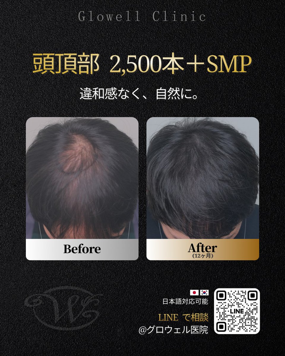 gwl26319900's tweet photo. つむじの透け感、意外と目立っていませんか？👀

2,500本植毛＋SMPで
毛量と地肌の見え方を同時にカバー✅

上から見たときの印象まで
自然に整えた症例です🙌

📍韓国・汝矣島 グロウェル医院
🌐日本語対応可能
https://t.co/9ZSIWhybJ8

#韓国植毛 #SMP #頭頂部薄毛 https://t.co/DiqThQN24C
