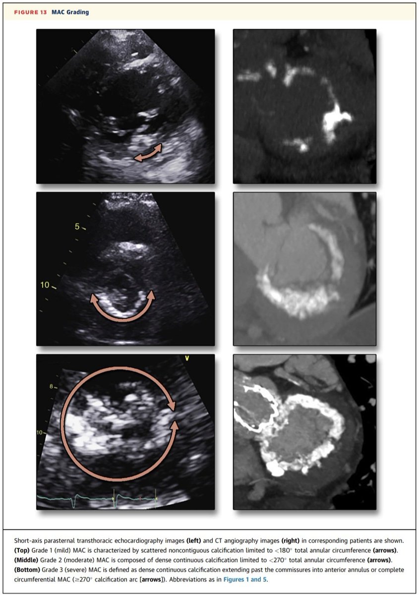 javier20ch's tweet photo. Calcificación Anular Mitral. 🫀❄️💥
💠La CAM es un proceso degenerativo crónico de calcificación del anillo mitral, predominantemente posterior.
💠F. Riesgo: edad avanzada, sexo femenino, ERC, HVI, HTA, estenosis aórtica, radioterapia mediastinal.
💠Diferencia con la EM reumática: en la CAM la calcificación progresa desde el anillo hacia las valvas, restringiendo su movilidad, pero sin fusión comisural.
📐 Clasificación anatómica propuesta:
Grado 1️⃣ (leve): calcificación focal no contigua <180°.
Grado 2️⃣ (moderado): calcificación densa continua <270°.
Grado 3️⃣ (grave): calcificación que sobrepasa las comisuras hacia el anillo anterior o circunferencial ≥270°, pudiendo extenderse a valvas, músculos papilares o miocardio. 
💠Tratamiento: no existe terapia médica específica que revierta la MAC y la valvuloplastia mitral con balón no es apropiada para la EM calcificada. La cirugía puede requerir desbridamiento y reconstrucción del anillo, pero en MAC extensa presenta alta morbimortalidad, incluyendo riesgo de disrupción del surco AV. ⚠️🚫

📝🆓️⤵️ @JACCJournals 💯
https://t.co/Ayl7Fk9B0h
https://t.co/zFvs3KiLPH