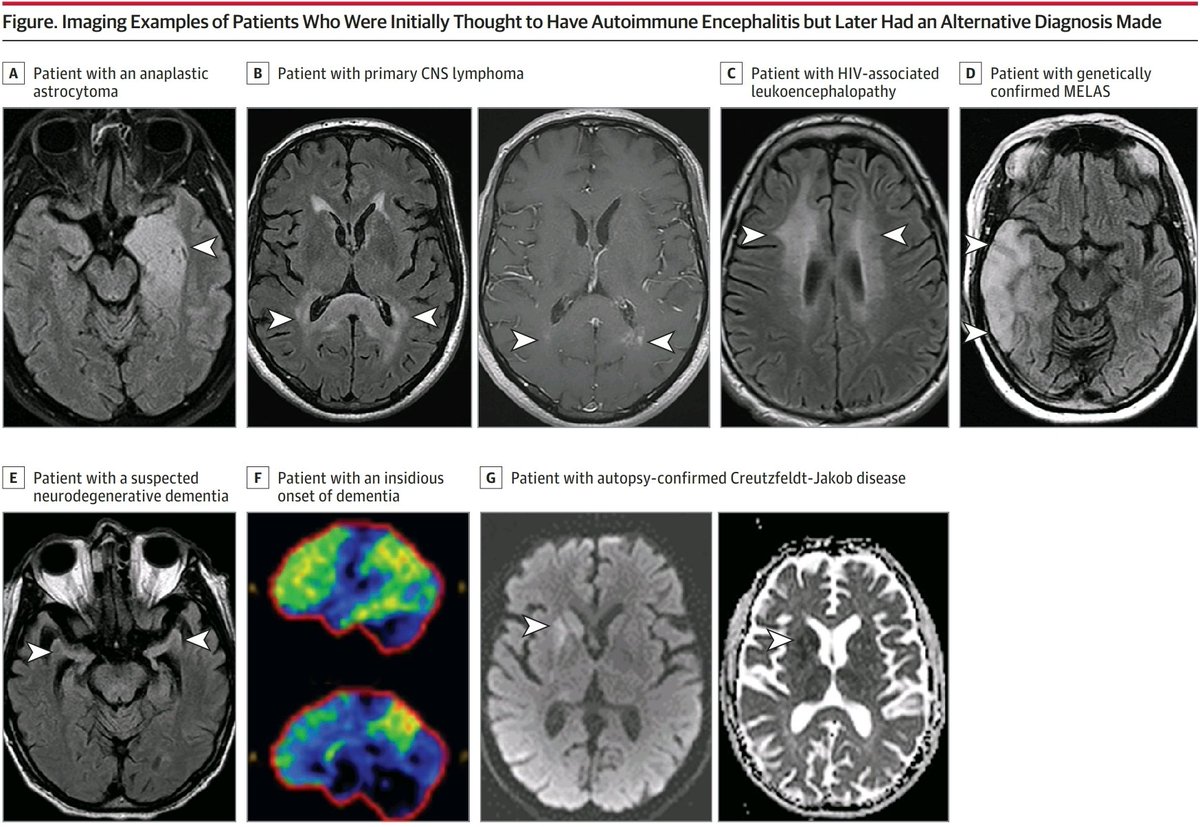 dr_heli's tweet photo. Excellent paper &amp; must read article on
Autoimmune encephalitis misdiagnosis in adults..

Look for etiologies: infections, metabolic, neurodegenerative, neoplastic, vasculitis etc causes

@Mayo_AING 
@EoinFlanagan14 
@Div_Dubey 
@JAMANeuro 
doi:10.1001/jamaneurol.2022.4251 https://t.co/EcNjOuP2xn