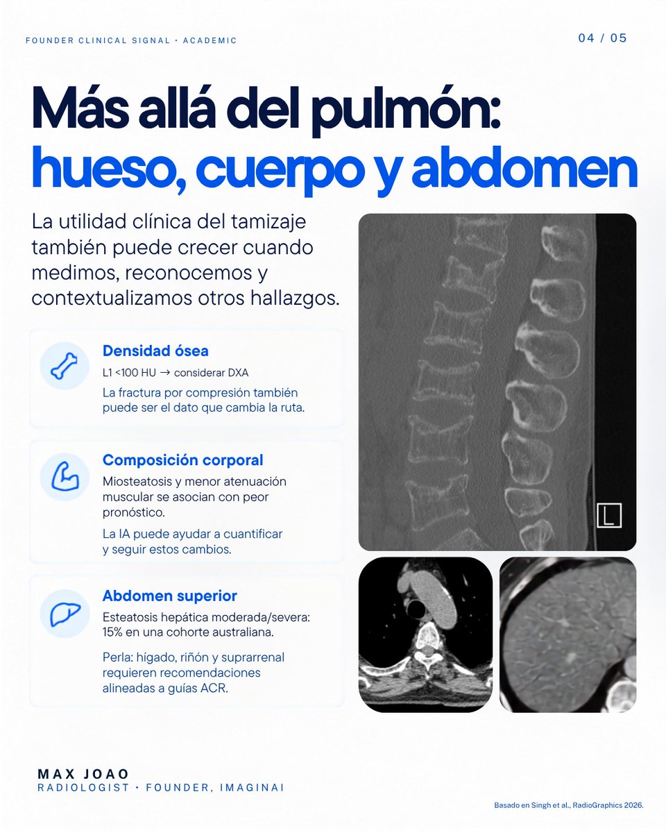 dr_maxjoao's tweet photo. El valor está en reconocer qué importa y medirlo bien.

Algunos números que vale la pena tener frescos:
31 mm · 4.0 cm · 100 HU
Los resumí junto con otras perlas prácticas en 5 slides. https://t.co/E9QcCwMce4