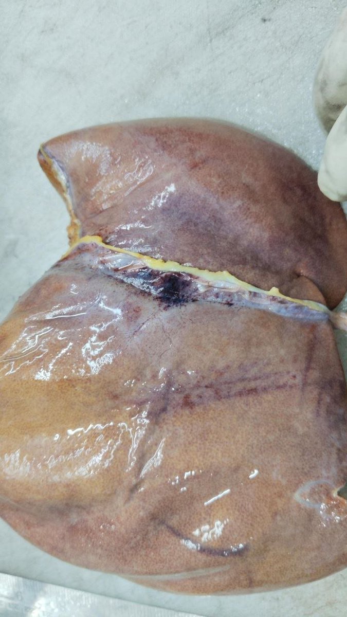 theliverdoc's tweet photo. Good morning. Please take your time to read this. It is important. I worry for my children and yours too. I waited for a while to tell you the story about this liver. 

I wanted to make sure it ended well. This is was the liver of a teenager we took out a month back. He was flown in from another State because of an unidentifiable jaundice + hepatitis that was making him sick. Hardly a few days in, he went into a coma because of liver failure and we put him on a ventilator. To help him survive, a parent donated part of the liver. This was the quickest emergency liver transplantation we ever did. Everything happened in less than 24 hours.

On the outside the liver looks pretty normal, just a bit swollen from the hepatitis (liver inflammation). But when we looked at it under the microscope, there was nothing left. Almost all the liver cells were wiped out (a finding known as massive hepatocellular necrosis) with deep inflammation. 

The cause remained unknown. We call it indeterminate hepatitis - meaning, something we did not know, caused it. 

You may remember post Covid-19 era. There were multiple cases of unknown hepatitis among children which either led to them dying or receiving a transplant. At the time, scientists thought it was due to another virus - Adenovirus, that had changed the way it attacked us due to Covid-19 era restrictions and immune changes. But that theory fell apart because not every kid with indeterminate hepatitis had adenovirus positive.

In the 1980s, some doctors in few hospitals across the world described a handful of single-center cases that first documented liver cell loss and inflammatory infiltrates in unexplained pediatric liver failure. And they kept seeing such cases, here and there, and forgot about it. Some died. Some lived after a liver transplant.

In 1999, with the establishment of the Pediatric Acute Liver Failure (PALF) study group allowed for systematic tracking and larger-scale retrospective and prospective analysis of immune functionand dysfunction in such kids with unknown hepatitis.

In 2022, medical scientists were armed with better technology and more impressive analysis methods. And global attention surged, in the post-Covid-19 era on outbreaks of severe acute hepatitis of unknown origin in children.
https://t.co/ktKVaLQjcQ

They figured it out. Just like we did. 

A special stain and a technical advancement known as immunohistochemistry, a lab test that used antibodies to find specific proteins in a tissue sample was deployed. A special type of immune cell, supposed to defend us, was going crazy. Cytotoxic T cells act as the body's security guards to find and destroy cells infected by viruses or those that turned cancerous. There was no cancer in our teenager. And teenagers and children with this disease before him. The most likely culprit was a previous viral infection.
https://t.co/JicKah98a4

Covid-19 probably increased this. The little fcker wrecks havoc on the immune system like no other. It makes the body go wild and attack itself. It has done this before in other other organs too. It is called molecular mimicry.

When you get infected with COVID-19, your immune system creates defenses—like antibodies—to target and destroy the virus. To do this, it memorizes the physical shapes and protein sequences of the virus. However, because some building blocks of the COVID-19 spike protein mimic the shapes of our own healthy human proteins, the immune system can experience "cross-reactivity". Your newly trained antibodies end up attacking both the invading virus and your own healthy organs because they cannot tell the difference.
https://t.co/8baDr9nvJa

Large numbers of children with indeterminate hepatitis have cytotoxic T-cell mediated hepatitis. And it can only be diagnosed through a liver biopsy before the kid got really sick or after a liver transplant when the kid was going to die.

The liver that you see below, is far from normal. Deep within these tissues was a horde of cytotoxic T-cells that were picking of large areas of liver cells, pushing the child towards death. 

As a doctor, I was only able to give them a diagnosis, after the liver came out and because they were convinced about this hidden killer of children, we did it in the nick of time. The teenager survived and we found what nearly killed the patient.

Any viral infection can lead to this. Not immediately, but even later on in life. It happens mostly in children, teenagers and young adults. Vaccines prevent/ reduce severity of various viral infections. Please make sure you and your children are vaccinated for age. 

I hope Governments everywhere promote annual vaccinations for Covid-19 too along with the flu-shot. Because there is a strong possibility that this is the one virus that can cause this type of damage on the liver, many months after the initial infection and we may never know - becuase Covid-19 can come and go silently.