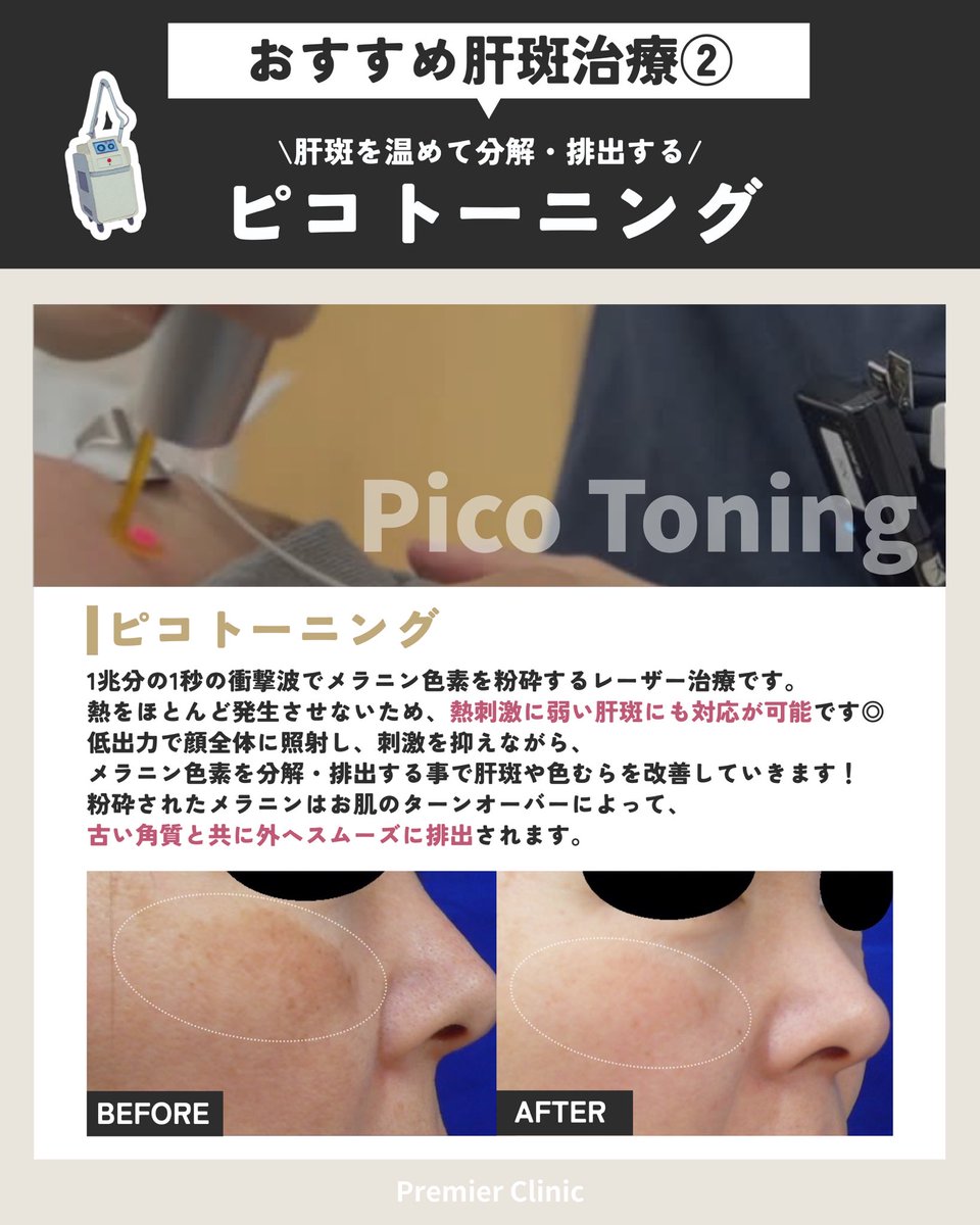 premier1clinic's tweet photo. 広島プルミエクリニック💎
広島県広島市中区本通7-29アイビービル4F

https://t.co/yUJ0d7E4Rp

肝斑治療なら広島プルミエクリニック

#広島プルミエクリニック #美容外科 #美容クリニック #症例写真 #美容皮膚科 #広島美容クリニック #美容治療 https://t.co/QZ8Mg4bara